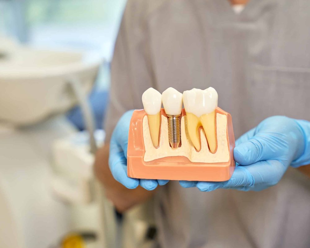 Selective focus of a dental implant model being held by a dental specialist in rubber gloves