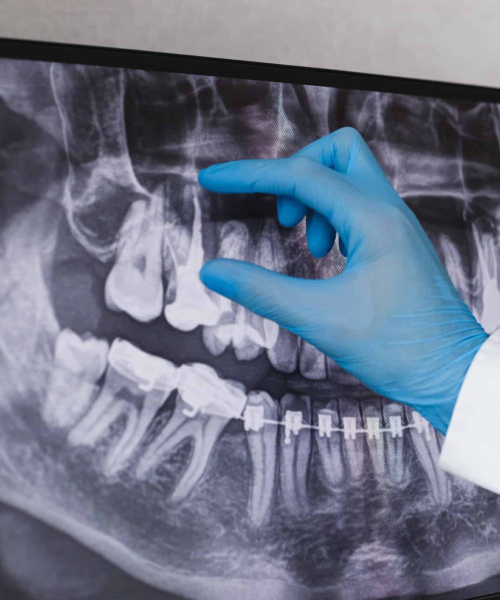 Doctor points to filled root canal in dental x-ray.